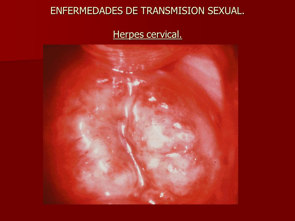 sexual herpes vaginal smell and pregnancy
